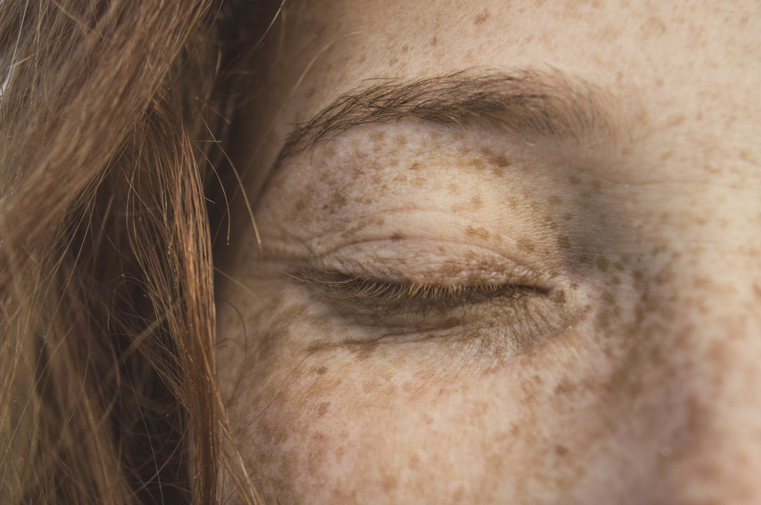 Melasma vs hyperpigmentation comparison showing facial pigmentation and uneven skin tone