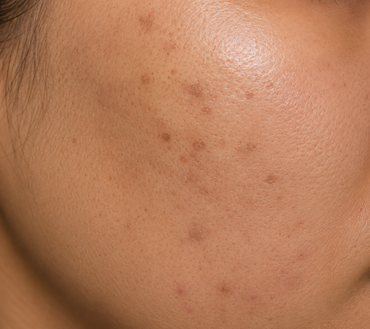 Before using Cosmelan Cream