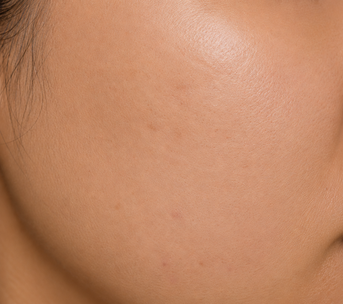 After using Cosmelan Cream